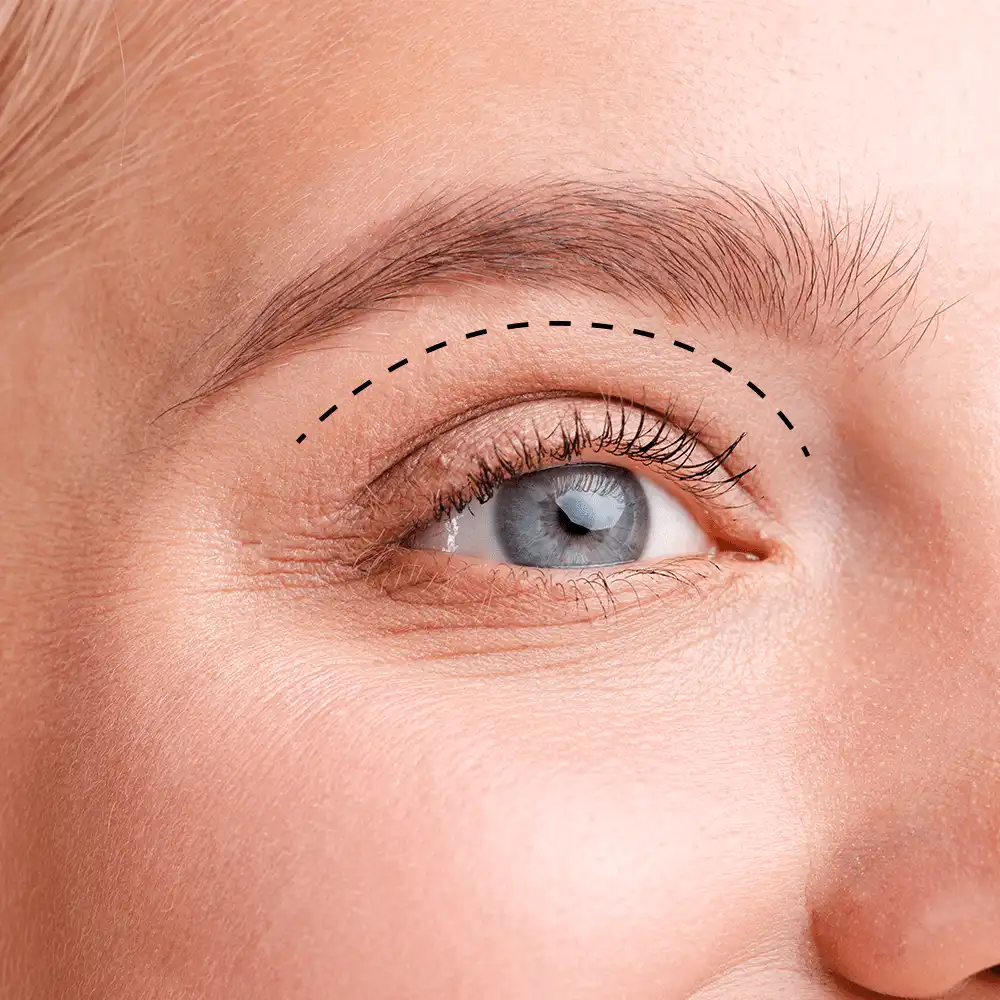 Blepharoplasty In Turkey ViviMedi