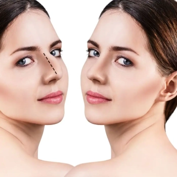 Septorhinoplastik in der Türkei